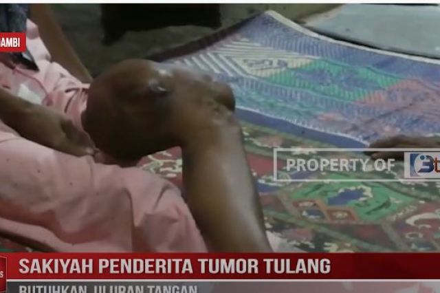 SAKIYAH PENDERITA TUMOR TULANG BUTUHKAN ULURAN TANGAN